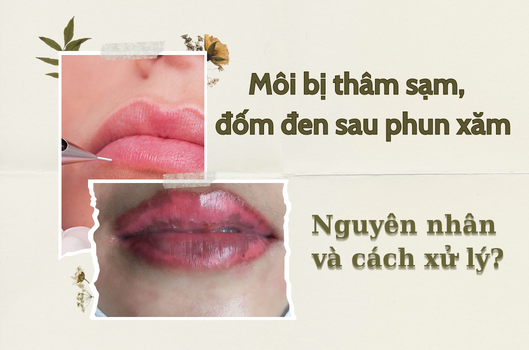 Môi Bị Thâm Sạm, Xuất Hiện Đốm Đen Sau Phun Xăm? Nguyên Nhân Và Cách Giải Quyết?